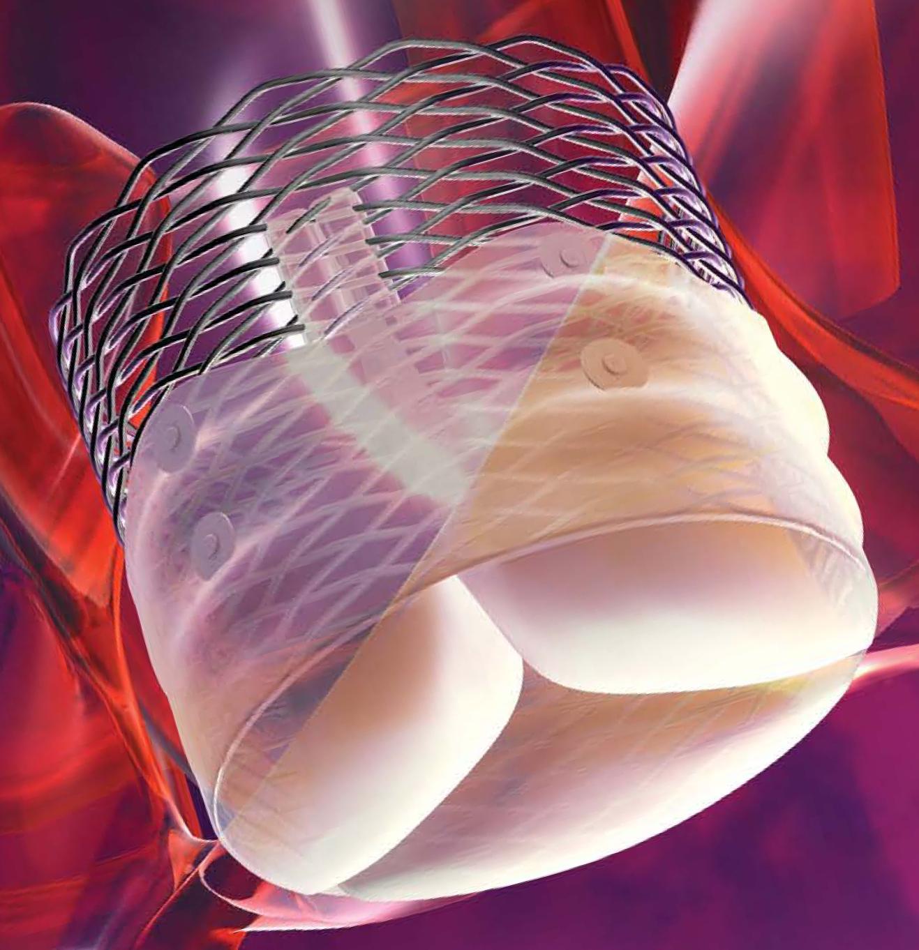 Boston Scientific Reports First Commercial Implants of Lotus Valve System in Europe