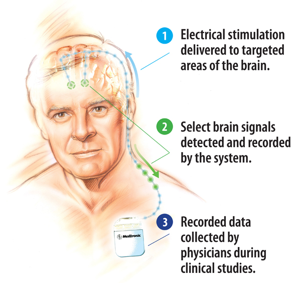 Developing Smarter Deep Brain Stimulation