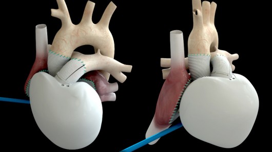 Why The Carmat Artificial Heart Could Be a Big Deal