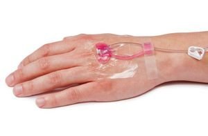 Tangent Medical Introduces Novacath Integrated IV Catheter System