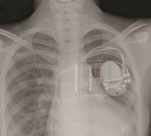 Check out This Tiny Pacemaker for Fetuses